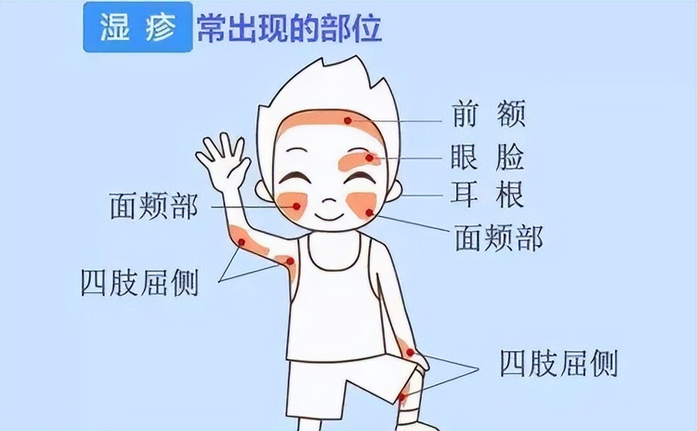 湿疹是什么引起的得了湿疹怎么办,得了湿疹怎样用中药调理