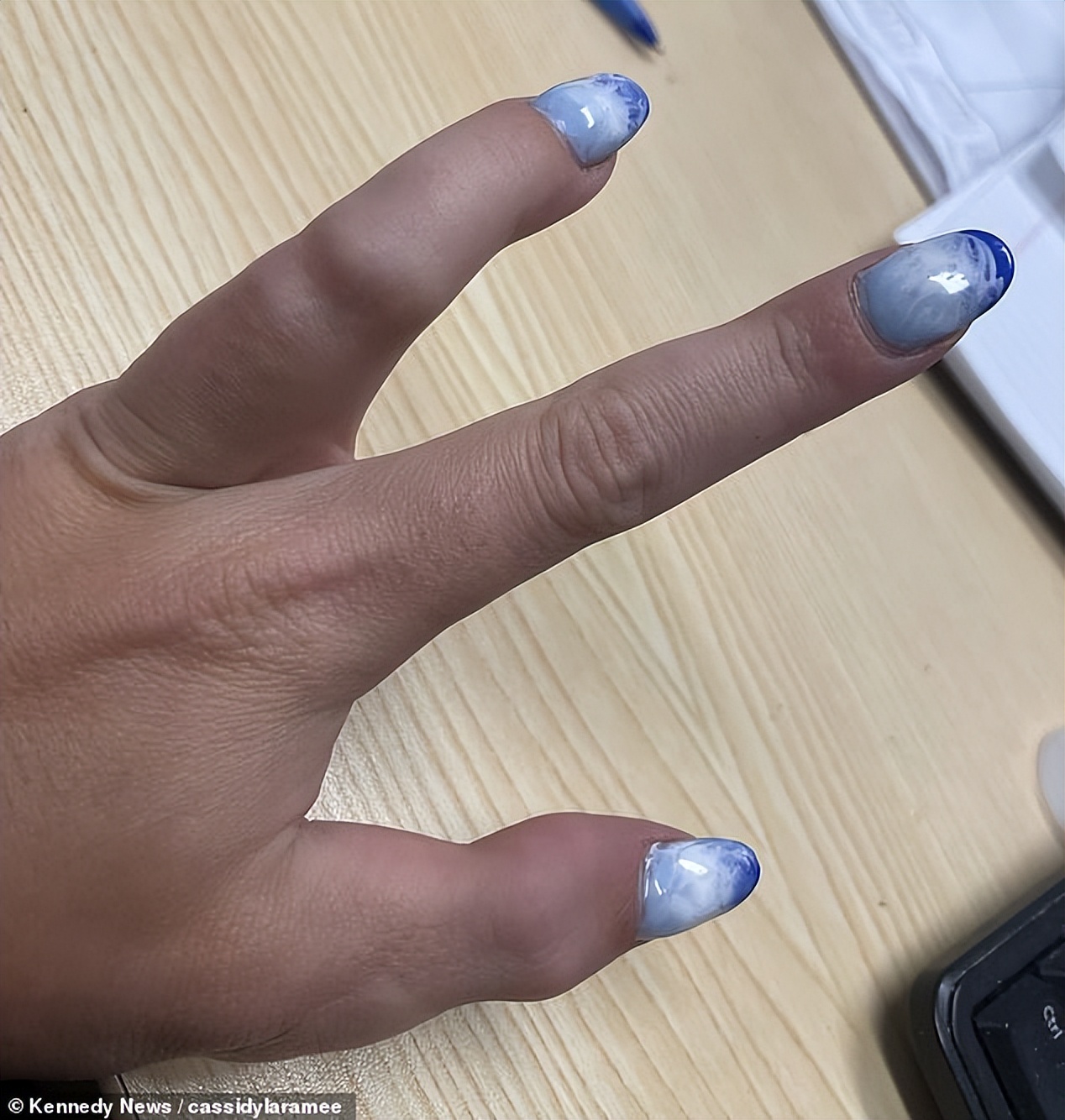 妹子天生只有3根手指，别人说她“霸王龙”，她用乐观狠狠反击！