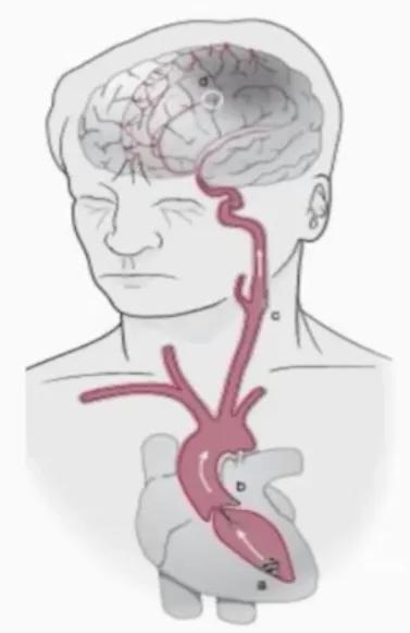 缺血性卒中治疗原则,缺血性卒中病因分型