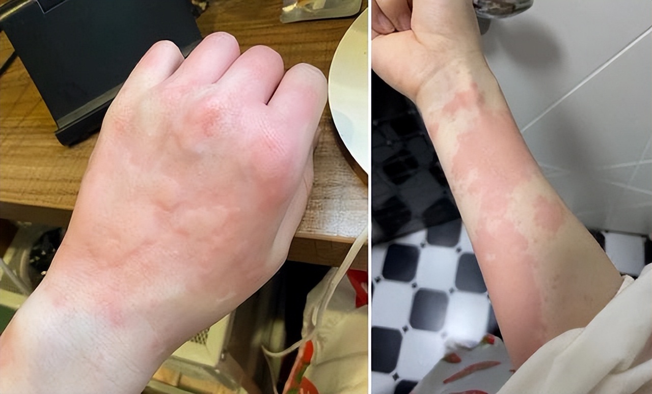 换季皮肤痒！一篇分享告诉你如何解决！