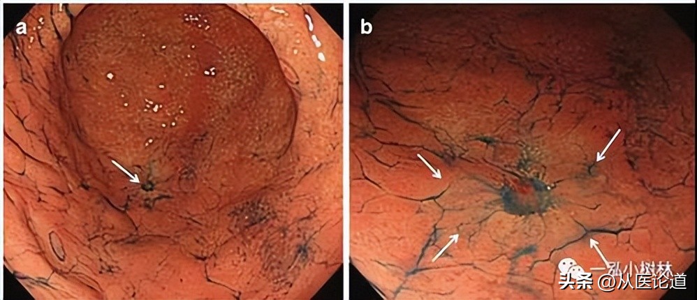 胃癌腹主动脉淋巴转移,胃癌及腹膜后淋巴转移