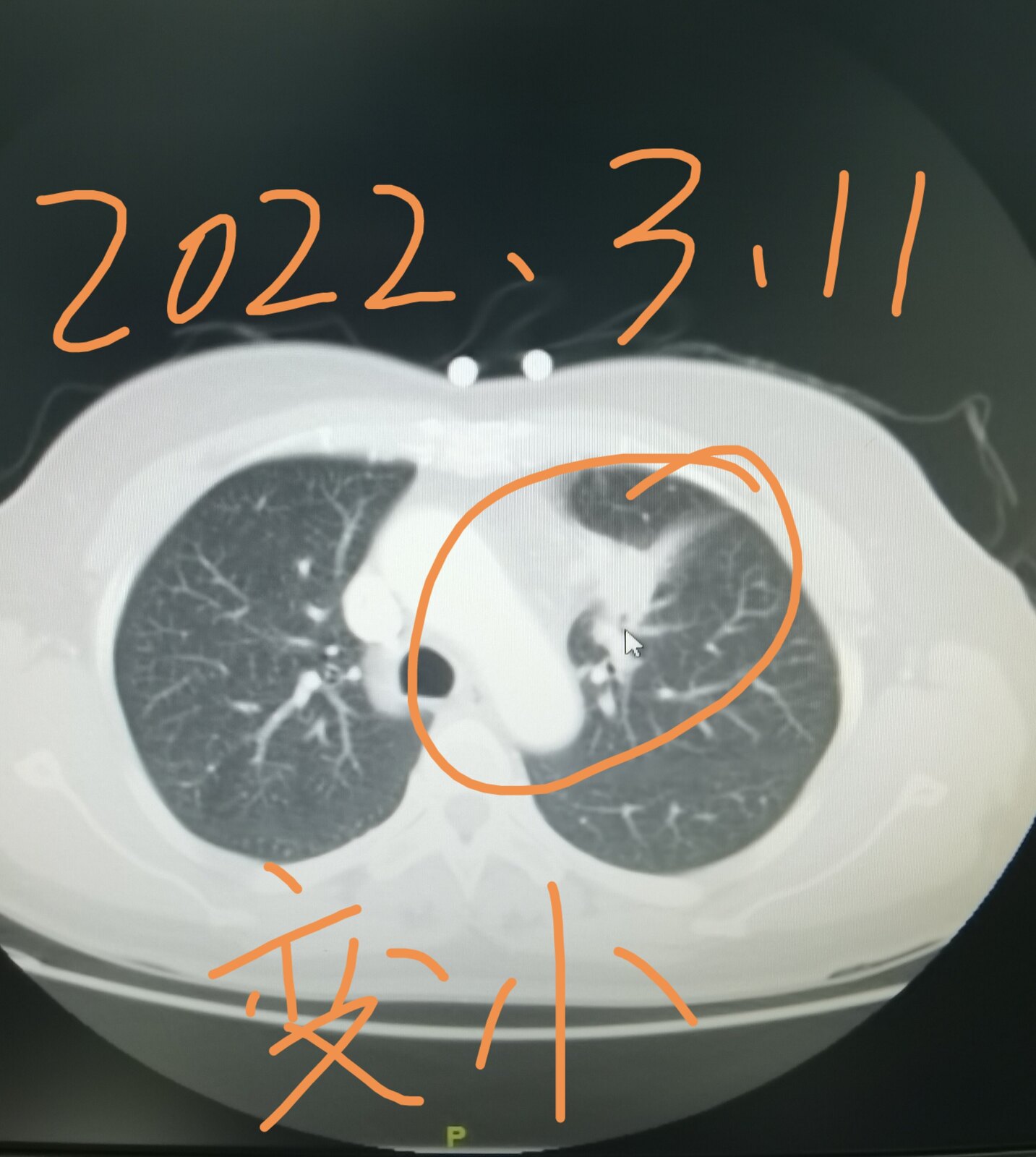 刘懿博士肺癌晚期症状,刘懿博士说肺癌微浸润复发