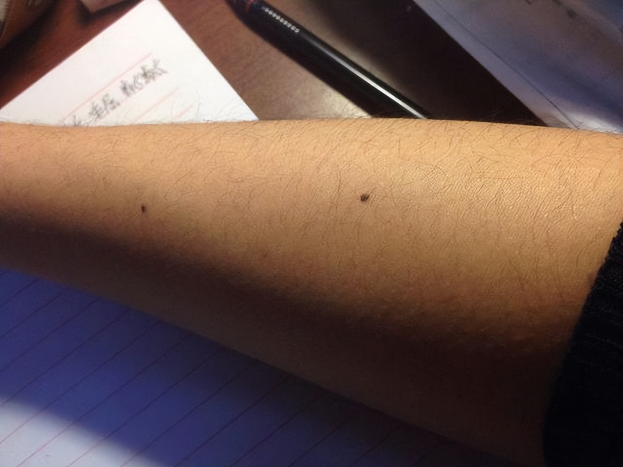 医生发现大黑痣的秘密,这些地方长黑痣要注意