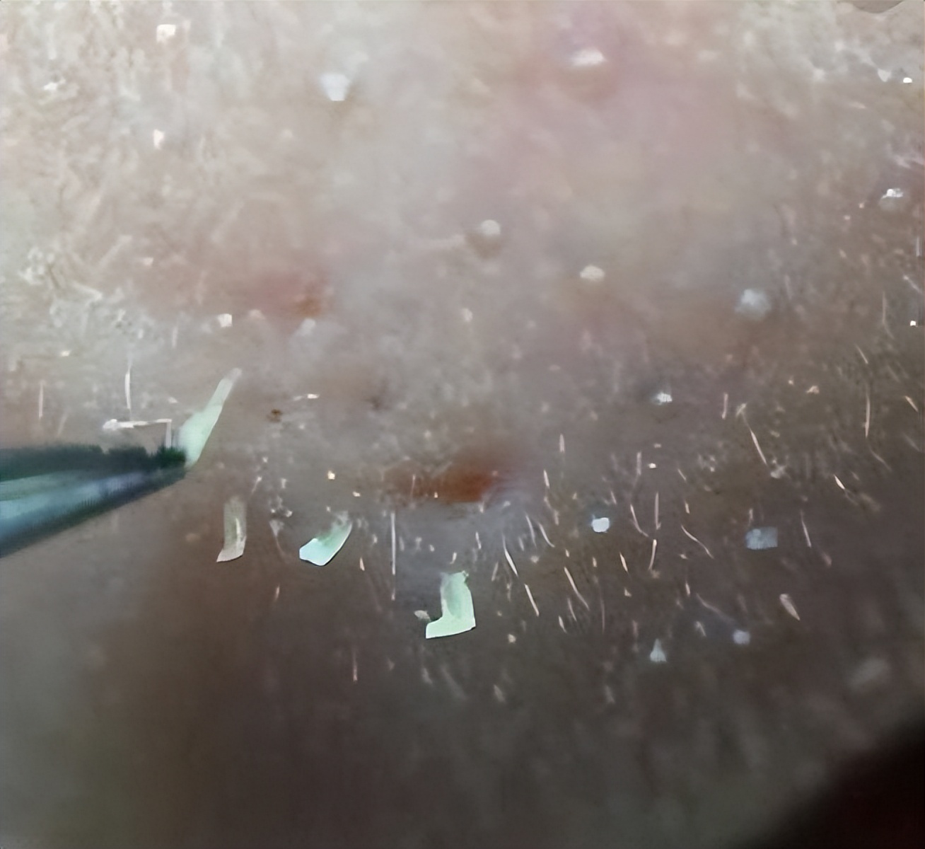 毛孔堵塞怎样才能疏通毛孔,身上毛孔堵塞不出汗怎么疏通毛孔