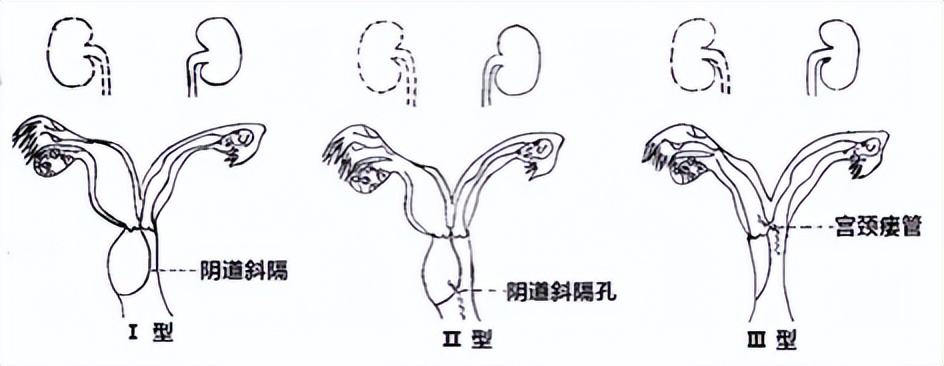 女子检查妇科发现体内有三个病,女子发现两个子宫