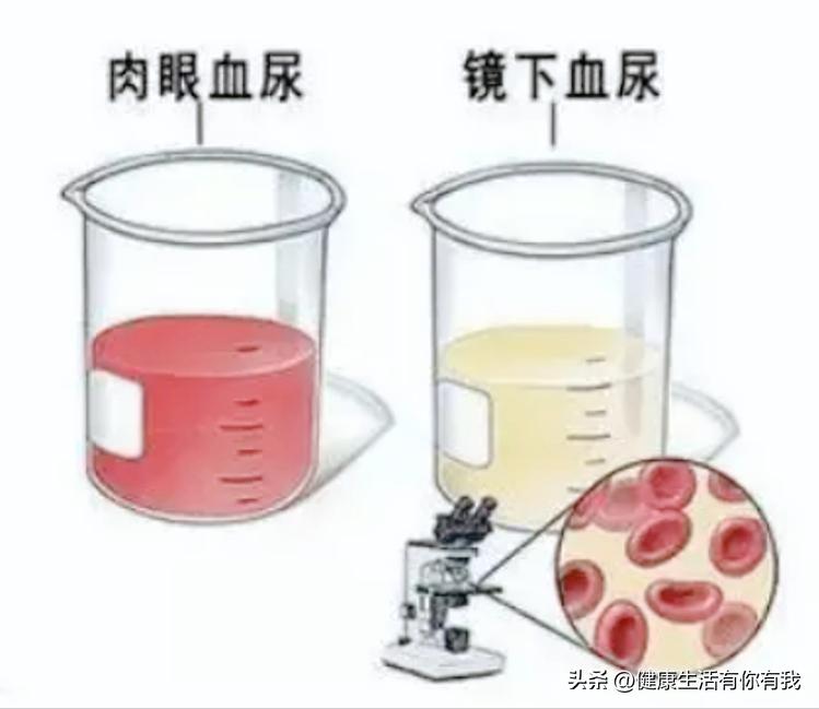 什么是血尿和尿潜血,什么是血尿是怎么回事