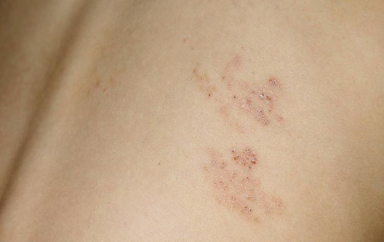 带状疱疹又叫“缠腰蛇”，该怎么治？医生：这10类人易被盯上！