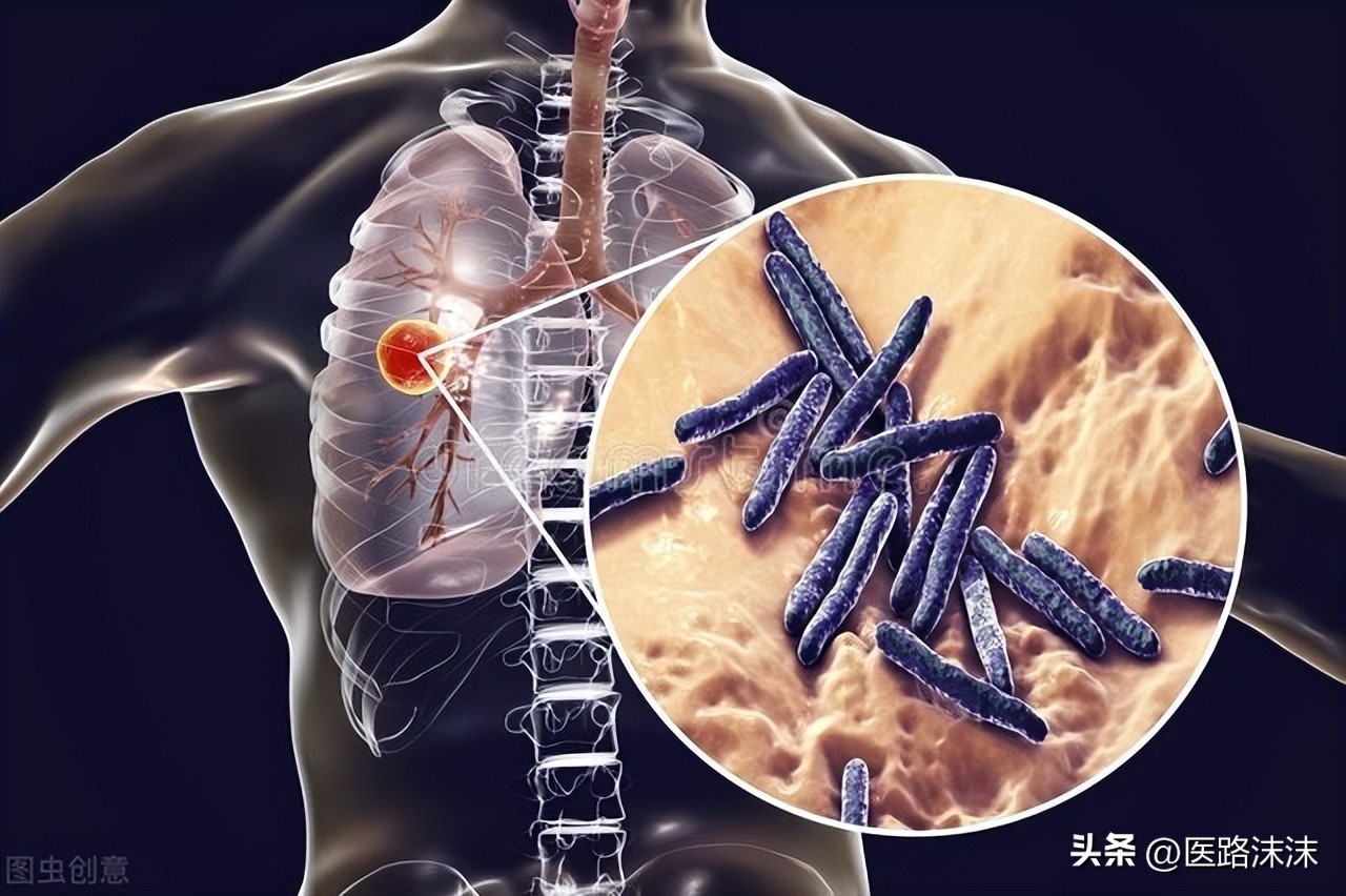 肺结核吃什么好得快,肺结核能治断根吗