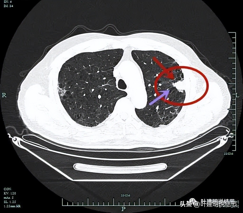 pet判断淋巴结转移,petct判断癌有没有转移准确吗