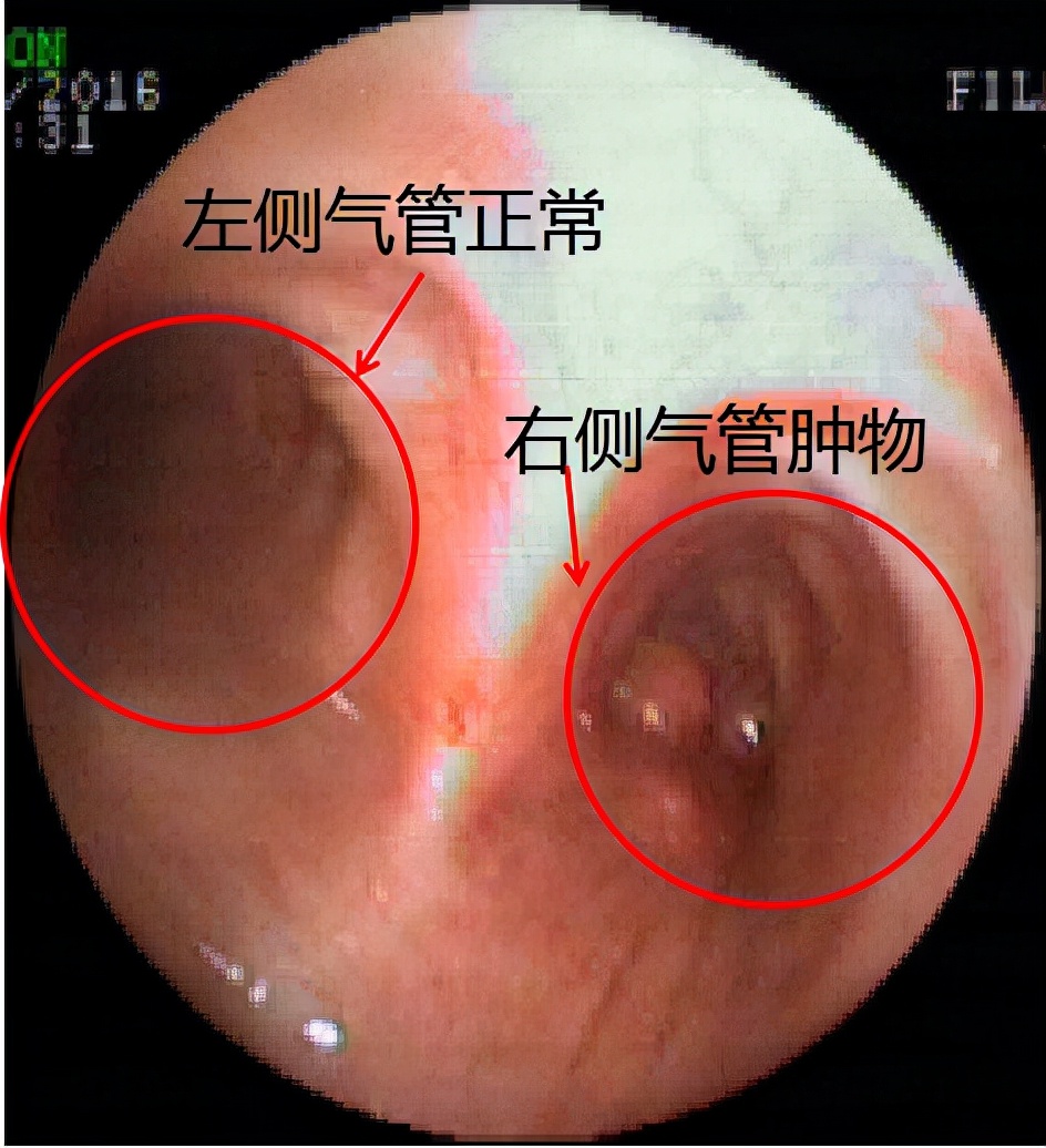 气管镜下肿瘤怎么治疗,气管肿物是什么