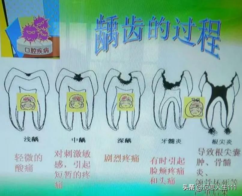 龋齿的形成原因和过程动画,龋齿发生机制的图片