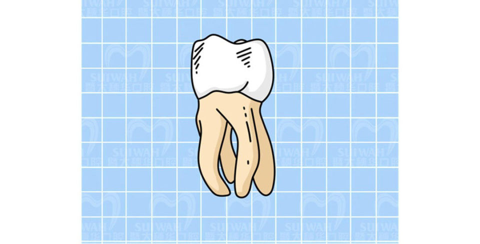 根管治疗为什么只要400块,有多少人接受过根管治疗