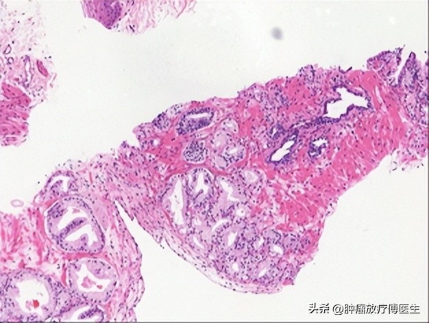 前列腺癌9级需要做化疗么,山西肿瘤医院前列腺癌放射治疗