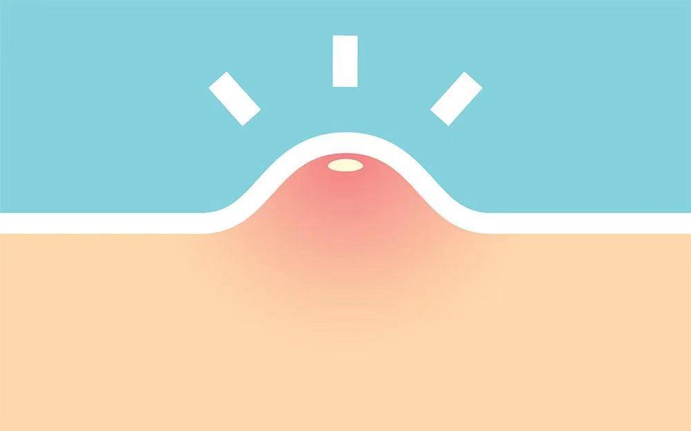 背后长了好多痘痘是性病吗,脖子下面长痘痘是性病吗