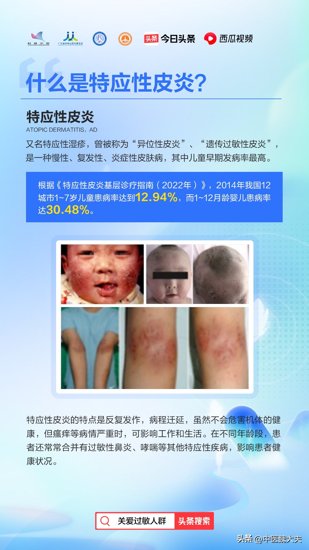 神经性皮炎奇痒难忍用什么药较好,12岁男孩全身奇痒该怎么办