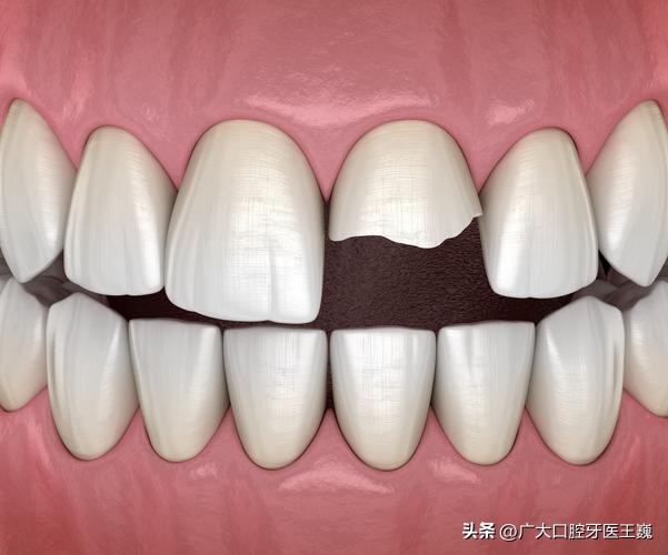 牙齿大门牙磕了一半怎么修复,口腔门牙上颚破了怎么恢复
