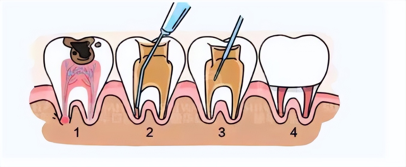 北京口腔医院根管治疗经历,东莞根管治疗经历