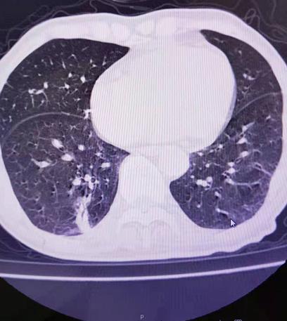 甲状腺结节消融术病例分析,肺部结节冷冻消融