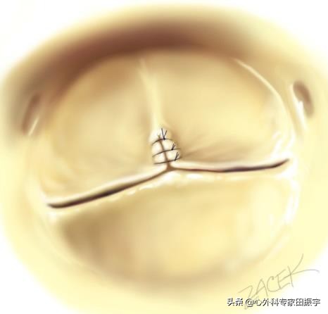 最先进的主动脉瓣二瓣叶畸形修复术（2020版）