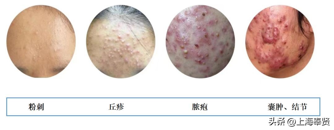 只要青春不要“痘”！解决青春烦恼方法多丨贤医健康说