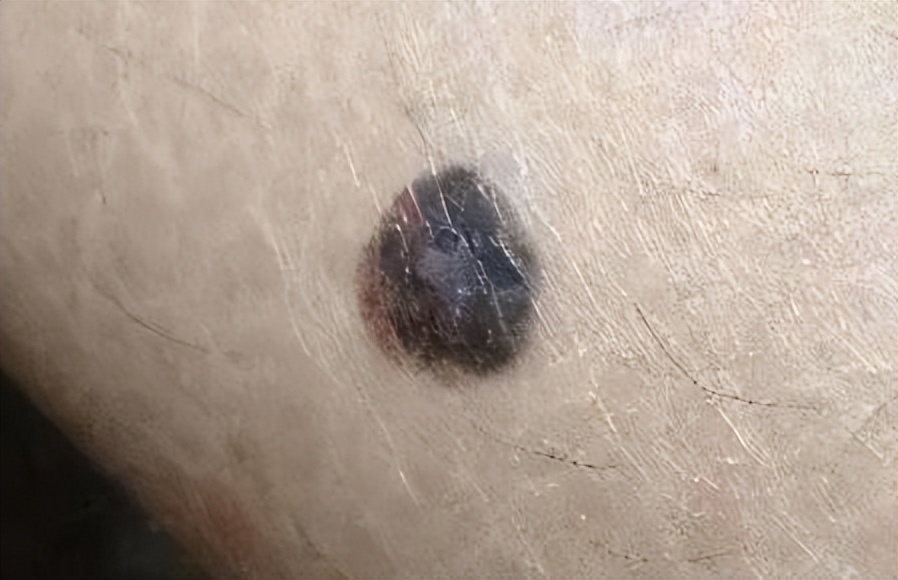 医生如何检查黑痣和黑色素瘤,医生长在摩擦部位的黑痣要当心