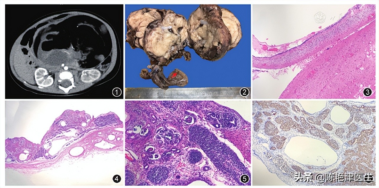 年轻妈妈妊娠纹严重的肚子照片,13岁女孩肚子爬满妊娠纹吓到妈妈