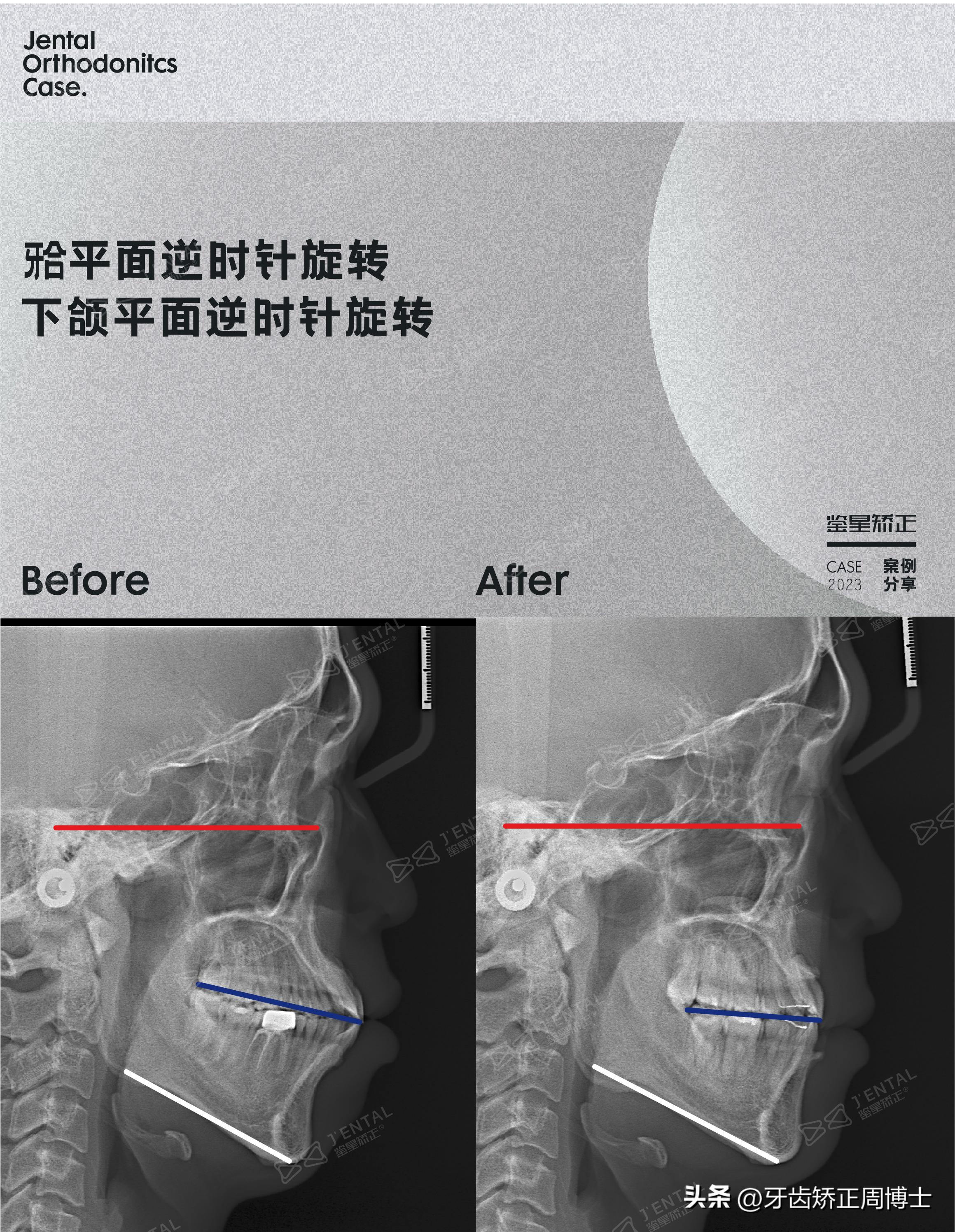 智齿正畸替代第二磨牙危害,智齿矫正代替第二磨牙3d图