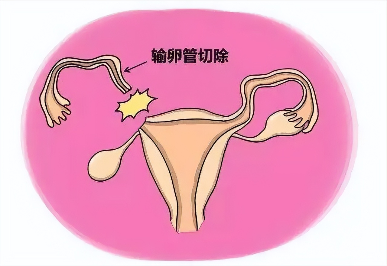 女子腹痛大出血,21岁女子剧烈腹痛抢救不及时