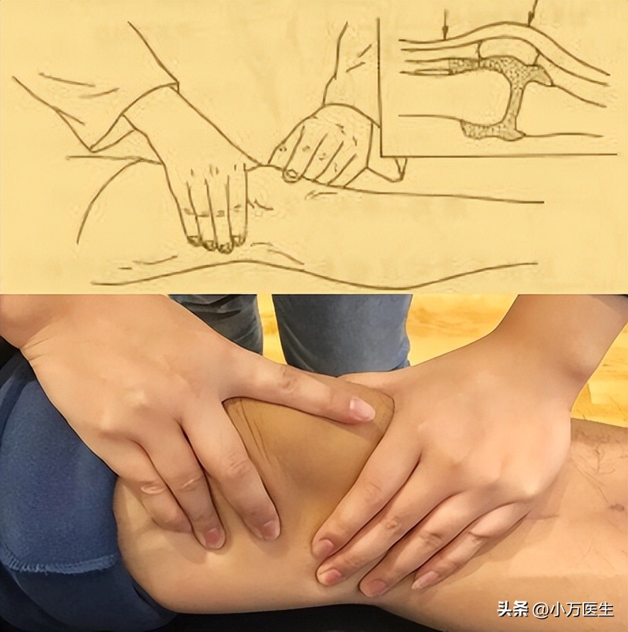 半月板后角撕裂微创手术,半月板撕裂分型