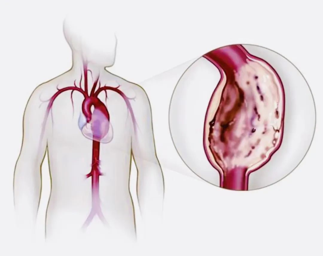 如何拆除“胸主动脉瘤”这颗定时*弹炸**？重庆大学附属肿瘤医院已常规开展这项精准“拆弹”技术