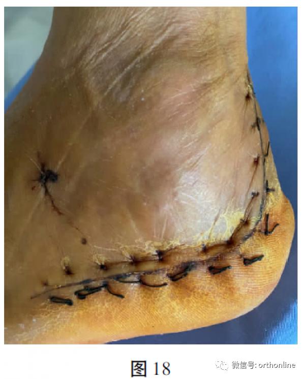 跟骨术后l型切口多久愈合,跟骨截骨矫正手法