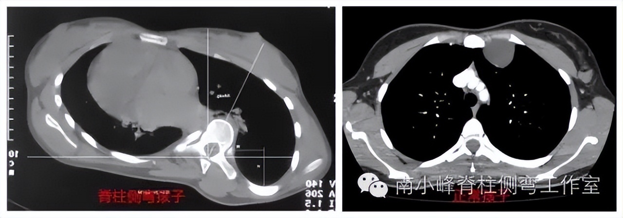 小孩脊柱侧弯恶化怎么治,脊柱侧弯多少度会形成剃刀背