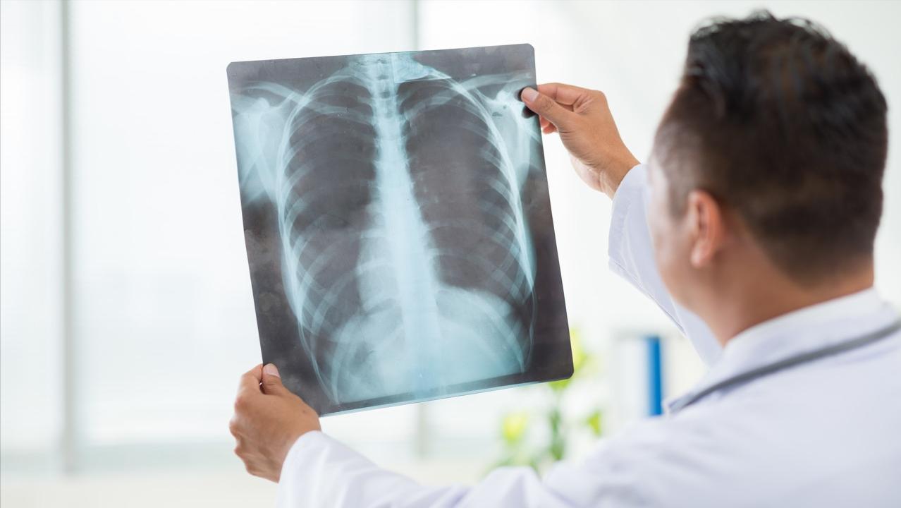 胸膜炎的胸痛和肺癌的痛哪个严重,经常胸闷咳嗽是不是肺癌