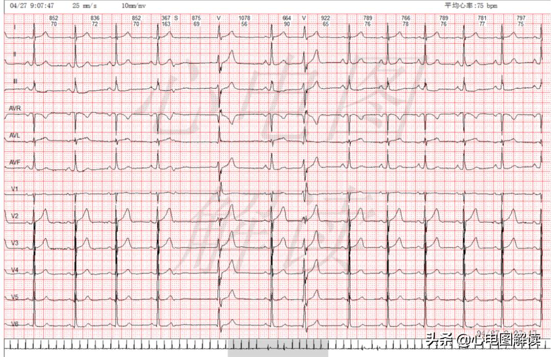 室性并行心律可能有间位性的吗,加速的室性逸搏心律的心电图表现