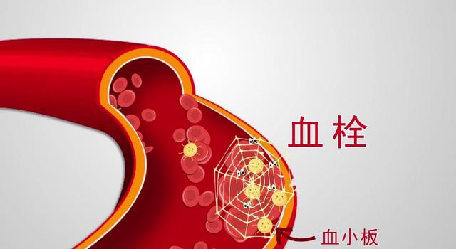 动脉瘤蛛网膜下腔出血术后并发症,动脉瘤导致蛛网膜下腔出血严重吗