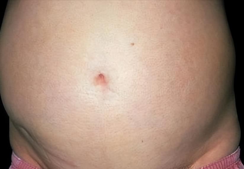 乙肝肝硬化腹水一般几天能消失,乙肝肝硬化有腹水了还能存活多久