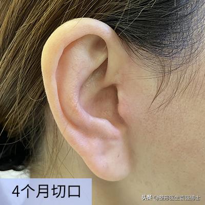 拉皮术后1-7天照片,科普一波大拉皮手术恢复期多少天