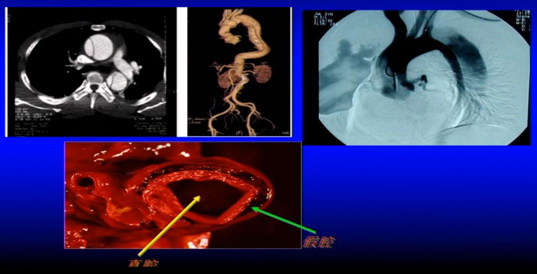 急性胸痛的诊断思路,胸痛知识总结