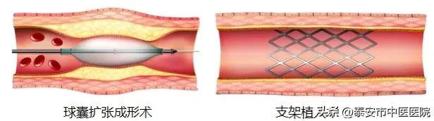 大连中医治疗下肢动脉硬化闭塞症,警惕动脉硬化的杀手