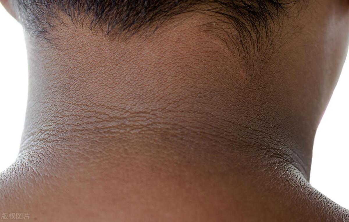 为什么肺癌一发现就是晚期，你要有两黑两咳一臭，建议早做肺部CT