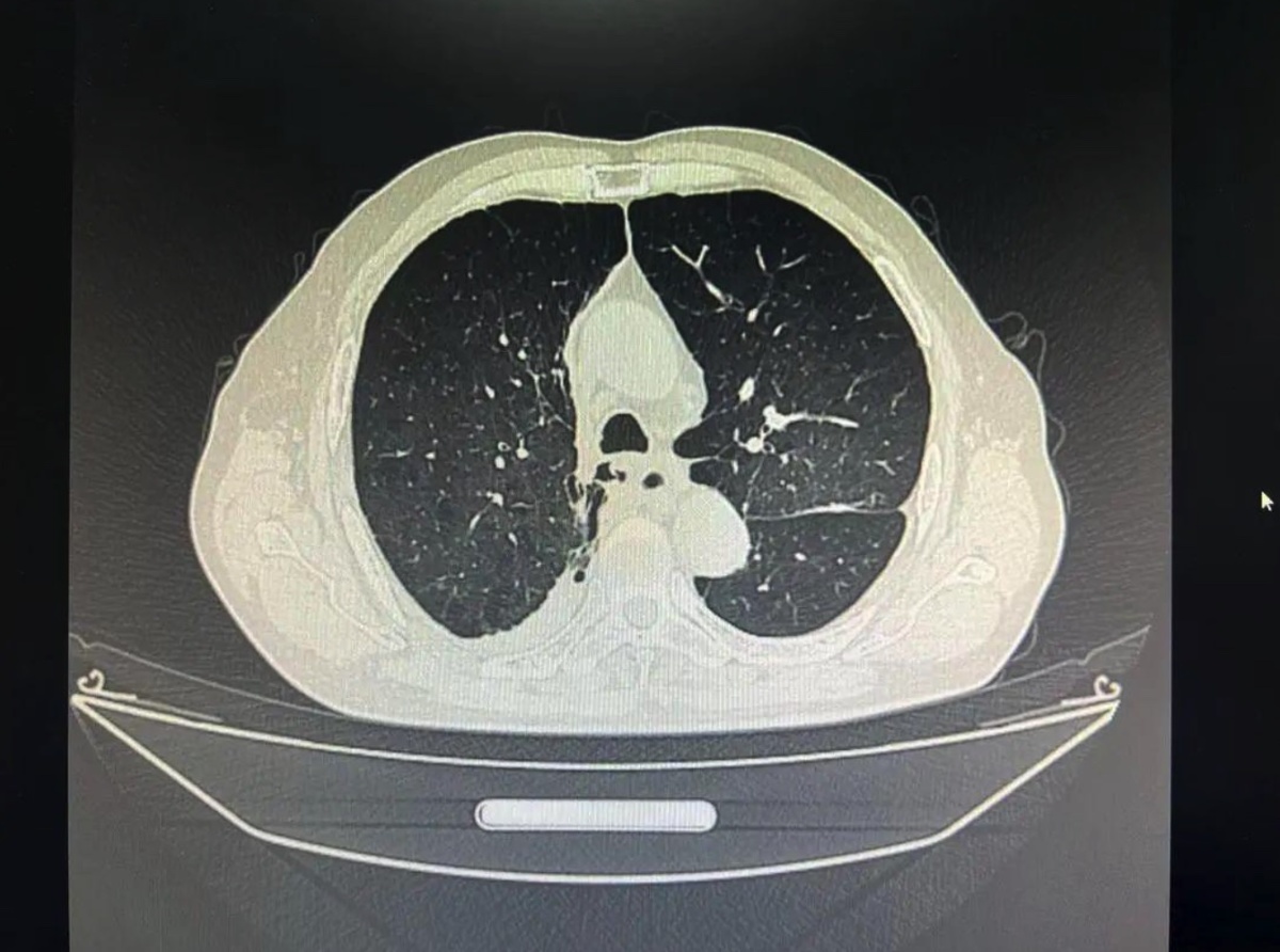 慢阻肺末期双肺移植,慢阻肺肺大泡手术有危险吗