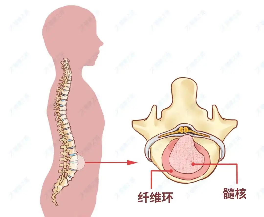 腰椎间盘突出老复发？这个错误“动作”你一定做过