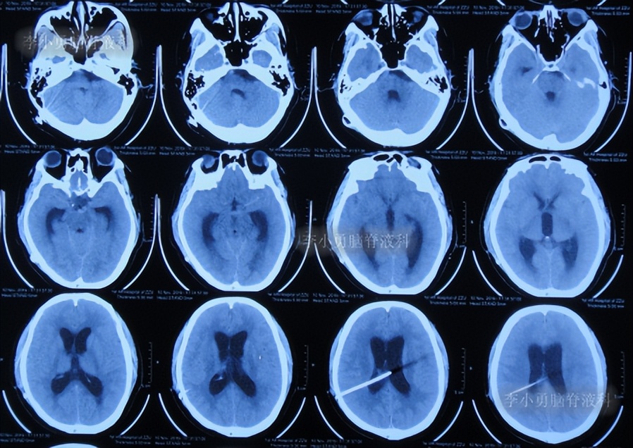 脑积水三脑室造瘘多久能恢复,脑囊虫手术后脑积水