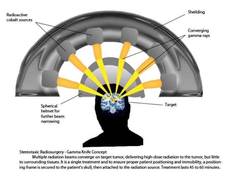 立体定向放射治疗和手术比较,立体定向放射和三维放射治疗技术