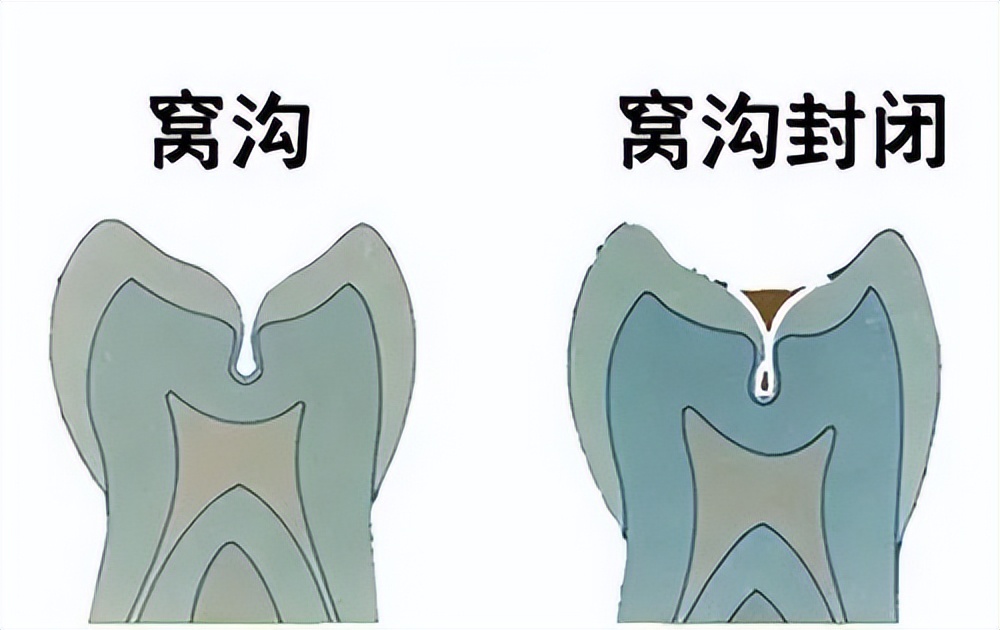 孩子牙齿黑色素沉着怎么去除,牙齿有黑点是色素沉着还是龋齿