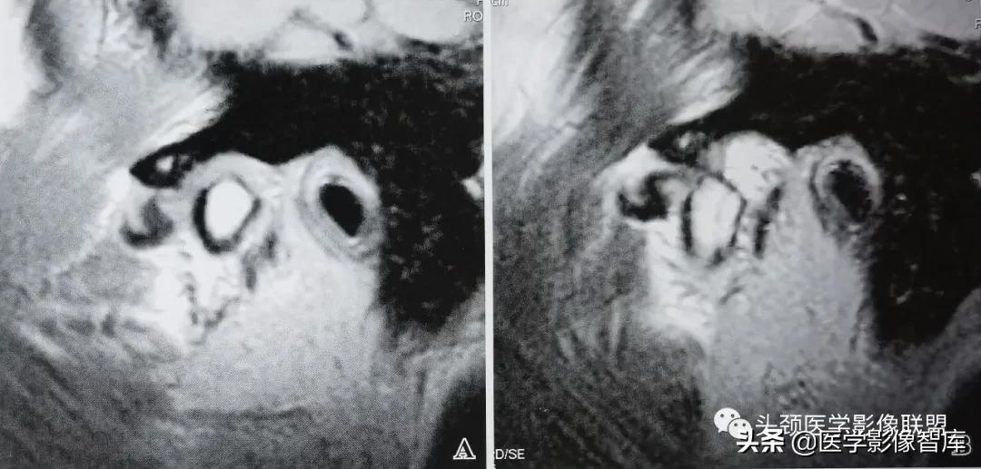 颞下颌关节移位怎么处理,颞下颌关节盘变形怎么治疗