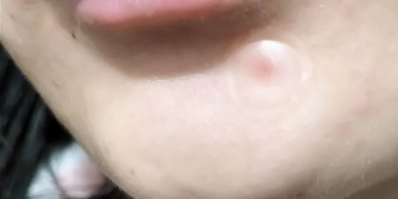 痘痘贴有用吗真实测评,痘痘贴真的祛痘吗