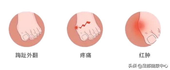 常见大拇趾疼痛原因,女性脚趾拇疼痛预示十种疾病