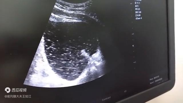 孔院长解读：什么是尿道疏通扩张术？配合前列腺钙化消融术...