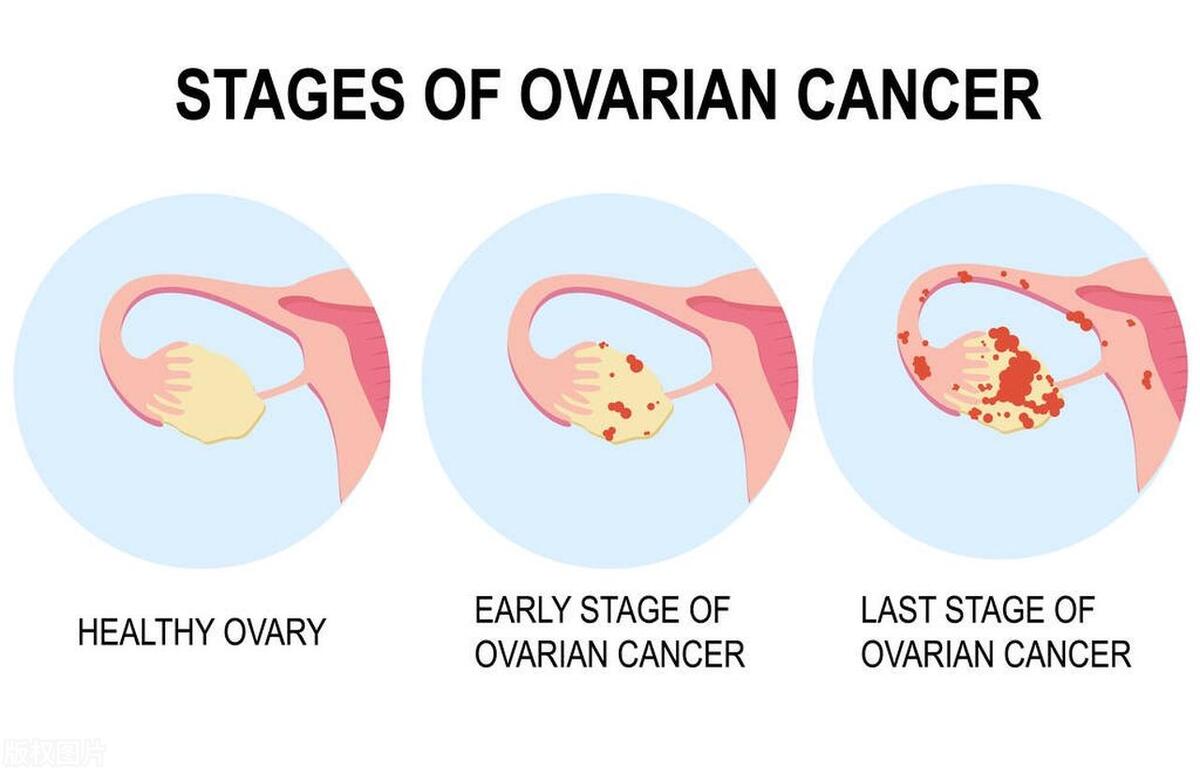 卵巢癌发现就是晚期吗,卵巢癌一发现就是晚期
